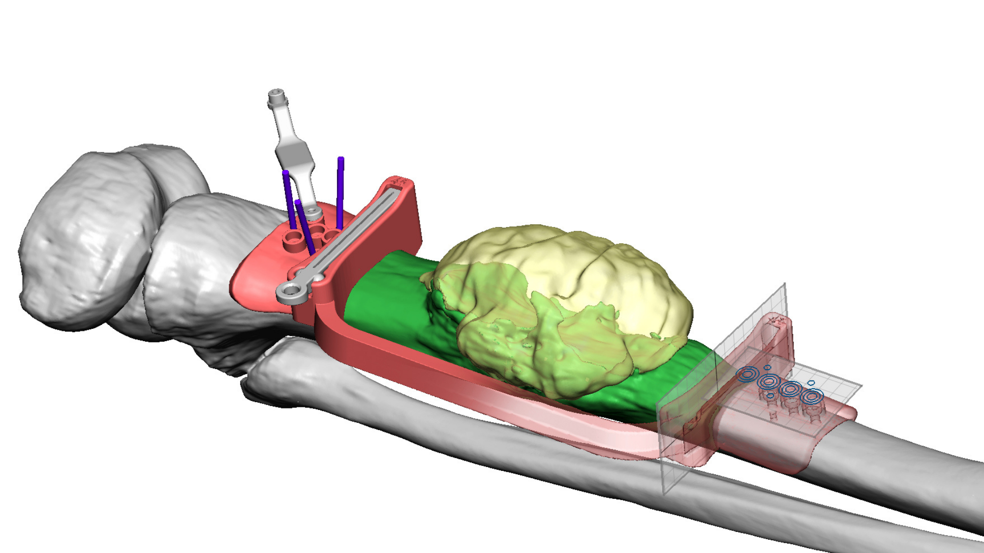 example of an orthopedic 3D surgical device